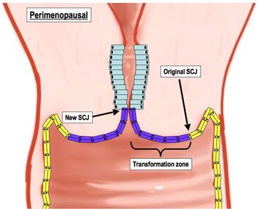 Perimenopausal cervix: transformation zone