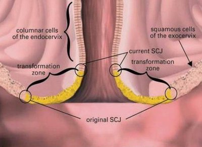 Transformation zone and SCJ