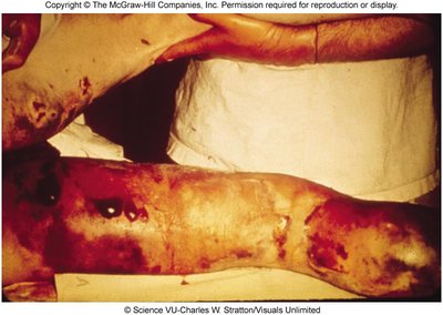 Extensive gas gangrene of the lower limb