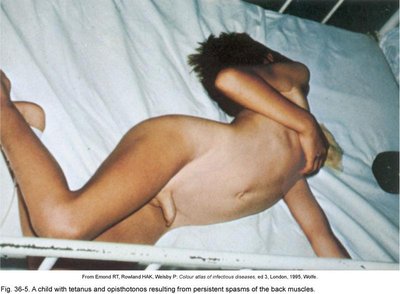 Child with tetanus and opisthotonos (back muscle spasms)