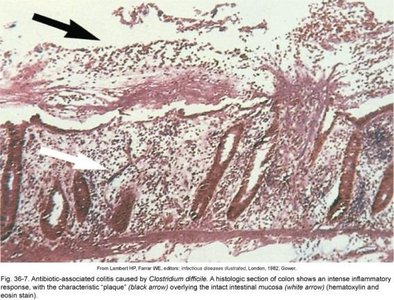 Histology of colon showing C. difficile-associated colitis with inflammatory plaques