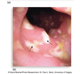 Endoscopic view of pseudomembranous colitis due to C. difficile