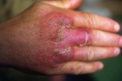 Erysipeloid skin infection on the hand