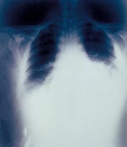 Chest X-ray showing widened mediastinum in pulmonary anthrax