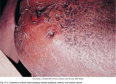 Cutaneous anthrax lesion with marked erythema, edema, and vesicle rupture