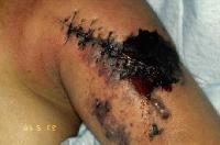 Severe gas gangrene in a surgical wound