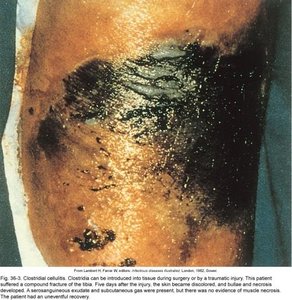 Clostridial cellulitis with tissue necrosis and gas formation