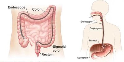 Endoscopy procedures for GI tract