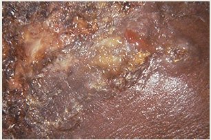 Crust (dried exudate)