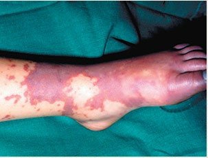Scale (flaking skin)