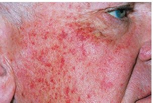 Purpura (large purple spots)