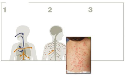 Chickenpox lesions on the skin