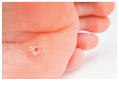 Plantar wart