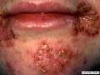 Streptococcal impetigo