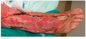 Necrotizing fasciitis