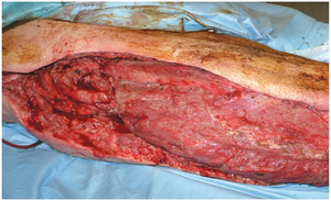 Necrotizing fasciitis