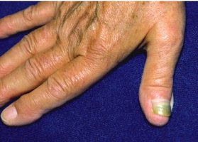 Pseudomonas aeruginosa infection