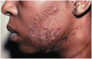 Severe acne