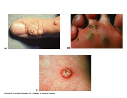 Warts