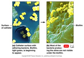 Staphylococcal biofilm on catheter