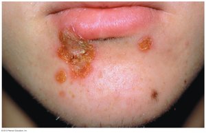 Lesions of impetigo