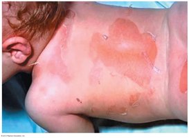 Scalded skin syndrome