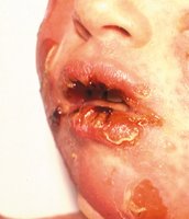 Scalded skin syndrome