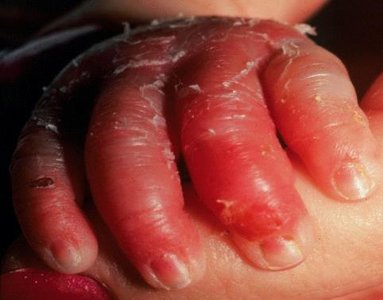 Scalded skin syndrome on hand