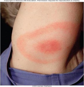 Bullseye rash of Lyme disease