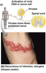 Shingles recurrence along a dermatome