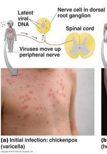 Chickenpox rash on torso