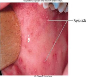 Koplik spots in measles