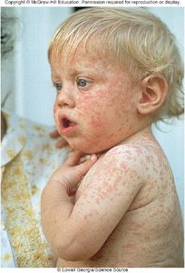 Measles rash on child