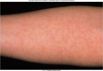 Rubella rash on arm