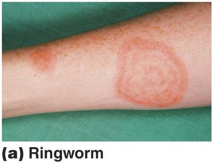Ringworm on arm