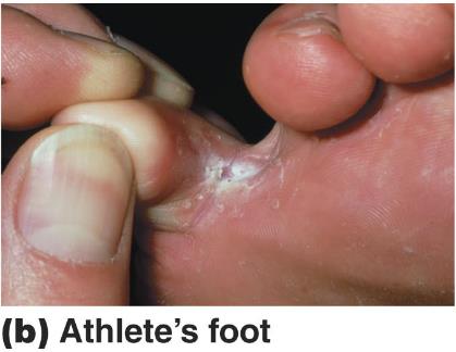 Athlete's foot between toes
