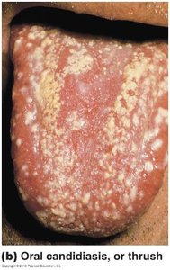 Oral candidiasis (thrush)