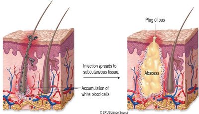 Abscess formation in hair follicle infection