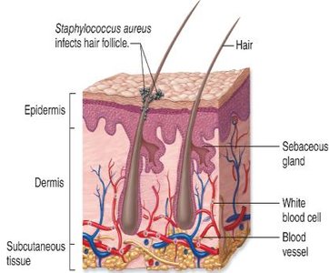 Staphylococcus aureus infecting hair follicle