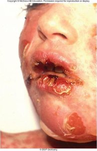 Severe impetigo around the mouth