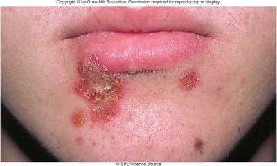 Impetigo lesions on the chin