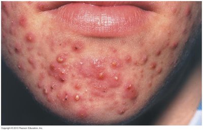 Inflammatory acne on the chin