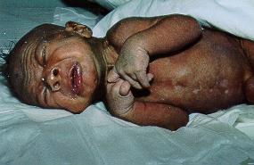 Muscle spasms of tetanus caused by neurotoxin