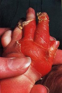 Diseases caused by Staphylococcal toxins