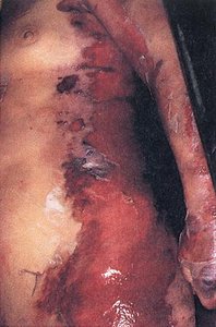 Scalded skin syndrome and toxic shock syndrome