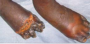 Severe gangrene caused by Clostridium perfringens