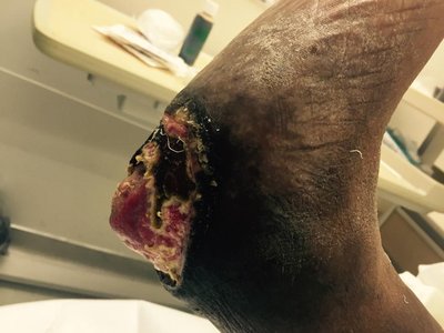 Tissue damage caused by microbial enzymes