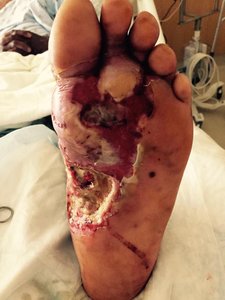 Tissue damage caused by Streptococcus pyogenes