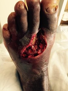 Tissue damage caused by Streptococcus pyogenes