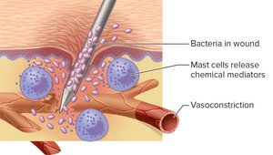 Early inflammation: mast cells release mediators